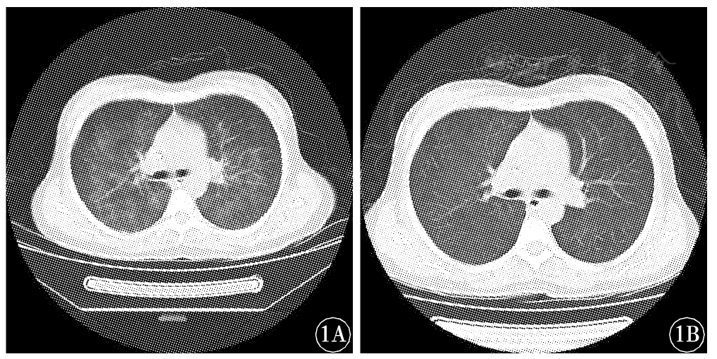 纹理增粗,模糊,胸膜下双侧分布的斑片样密度增高影;6例患者均进行了ct