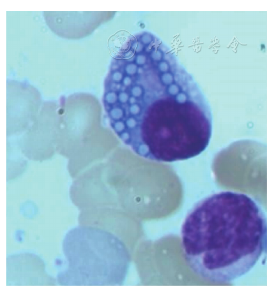 型多发性骨髓瘤患者骨髓细胞涂片可见含有大量空泡包涵体的mott细胞