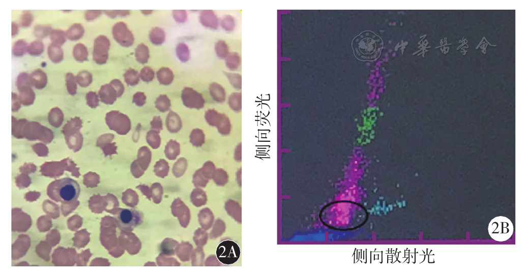 血细胞分析仪散点图及报警信息在恶性血液病诊断中的意义