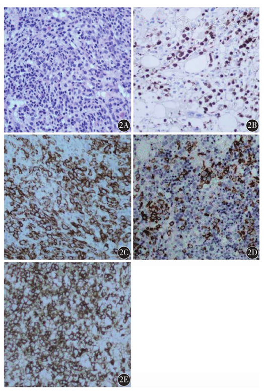 图2 原发骨髓弥漫大b细胞淋巴瘤患者骨髓组织形态及免疫组织化学结果