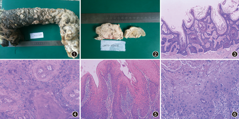 疣状表皮发育不良伴多发疣状癌及鳞癌一例 中华病理学杂志