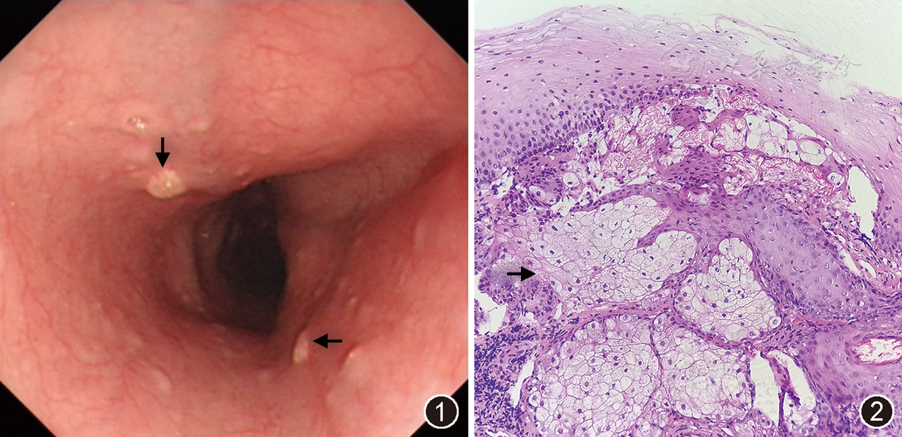 点击查看大图 图1 胃镜下见食管隆起型病变(箭头) 图2 显微镜下食管