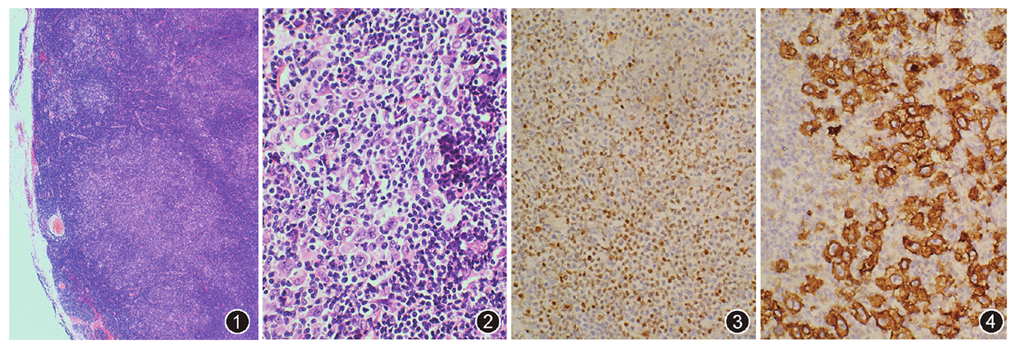 图1 淋巴结结构破坏,呈结节状生长 he 低倍放大;图2 炎性病变背景内