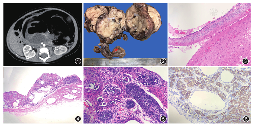 图1 腹部ct示腹腔内见混杂密度肿块影 图2 大体图像,囊实性肿块,实性