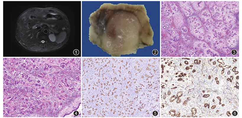 图2 胰腺肿物为单结节状,与周围界限尚清 图3,4 镜下见肿瘤中呈分叶