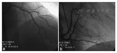 left circumflex artery as a terminal extension of