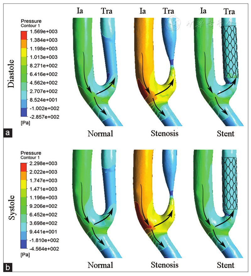 hemodynamics in transplant renal artery stenosis