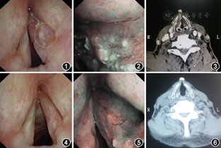 窄带成像内镜在喉癌化疗后病变范围判别中的应用