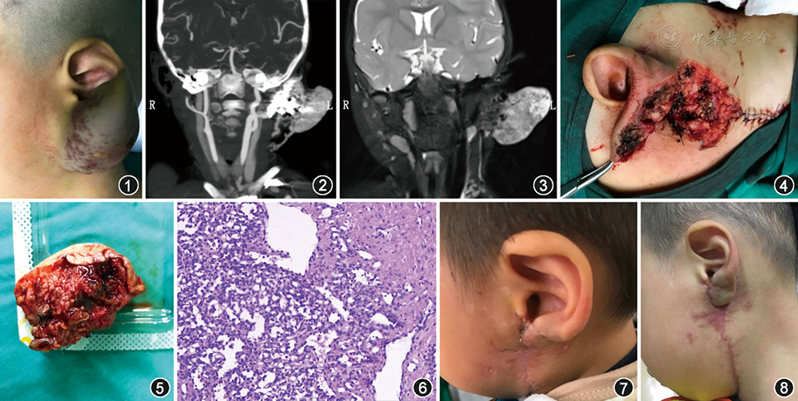 婴幼儿耳部巨大血管瘤一例