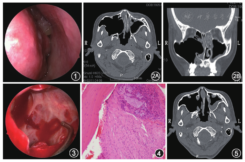 上颌窦气囊肿一例 中华耳鼻咽喉头颈外科杂志