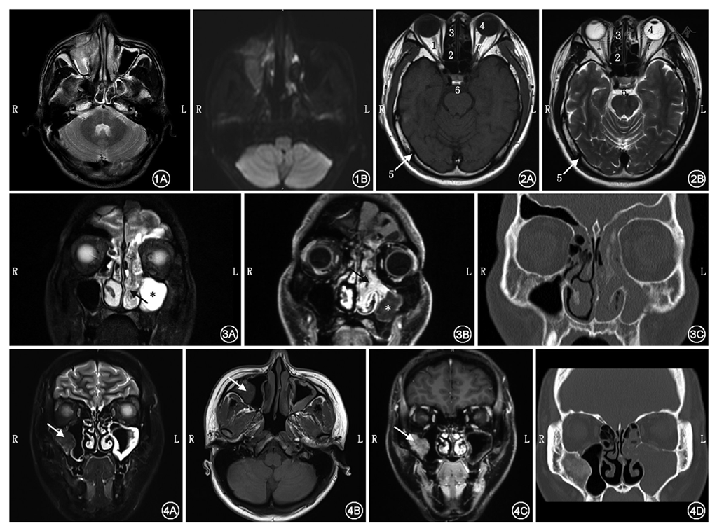 图1 右侧上颌窦肿物mri a:t2wi示肿物跨越上颌窦前壁生长;b:弥散加权