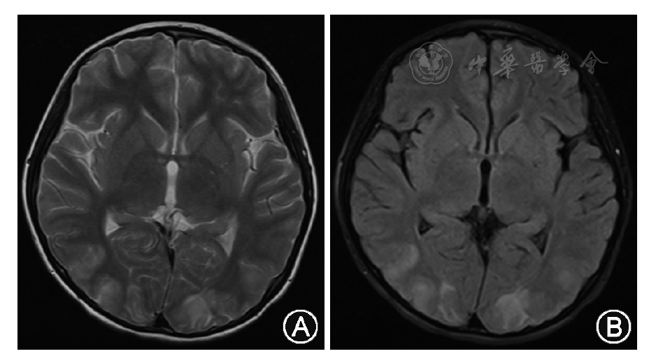 t2加权(图a)及flair成像(图b)显示双侧枕叶皮层下脑白质异常高信号