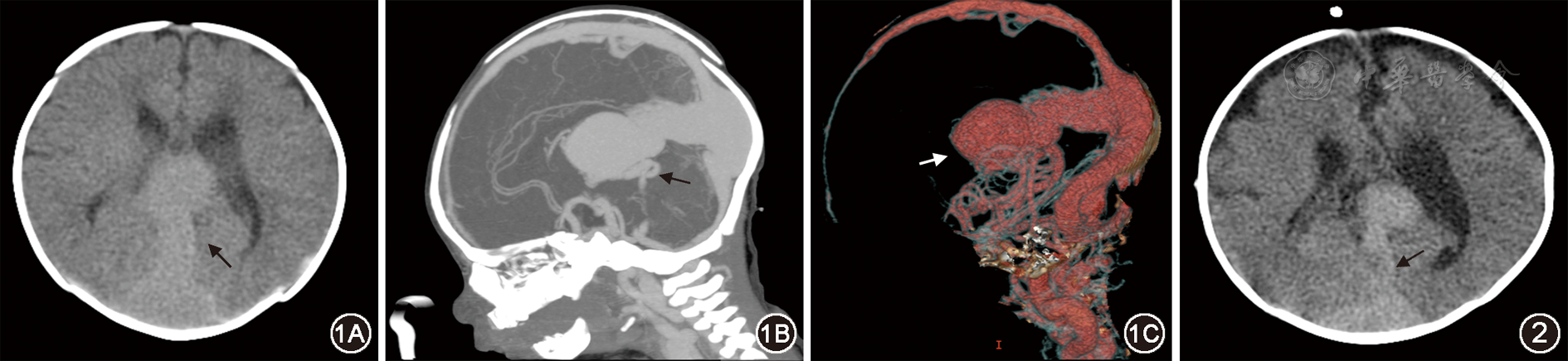 新生儿大脑大静脉畸形二例