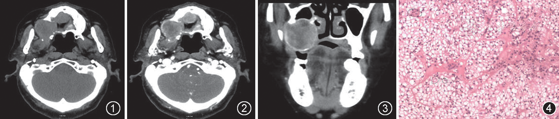 右上颌骨及腭部透明细胞肌上皮癌影像表现一例