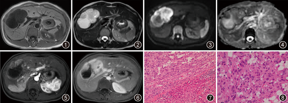肝脏上皮样间质瘤影像表现一例