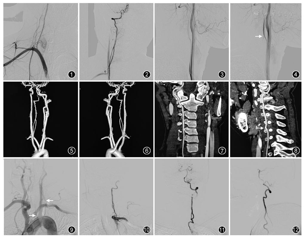 椎动脉双支起源变异二例