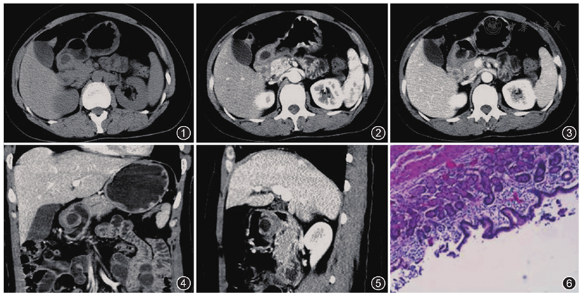 深在性囊性胃炎合并异位胰腺ct表现一例