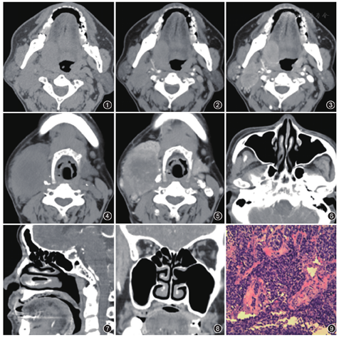 影像表现:鼻口咽ct平扫示右侧舌根部中等密度软组织肿块,3.2 cm×1.