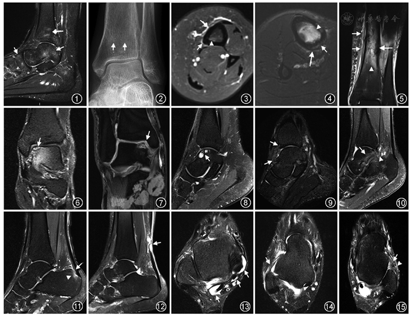 骨髓水肿,踝关节mri矢状面脂肪抑制(fs)-t 2wi示胫骨远端,距骨及足
