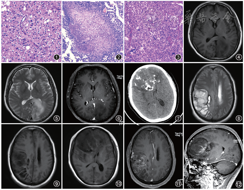 少突胶质细胞肿瘤的影像诊断与鉴别