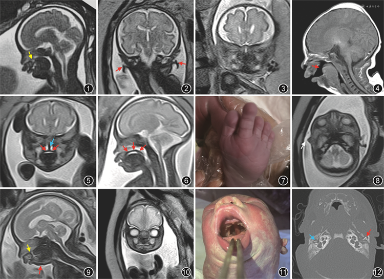 mri诊断2例胎儿pierre robin序列征 中华放射学杂志