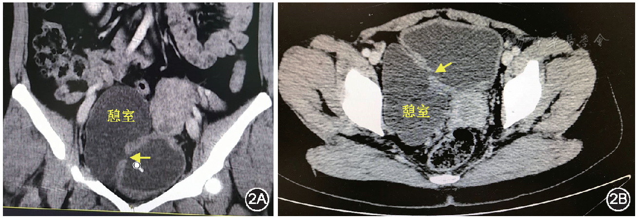 膀胱憩室影像学误诊为附件囊肿一例