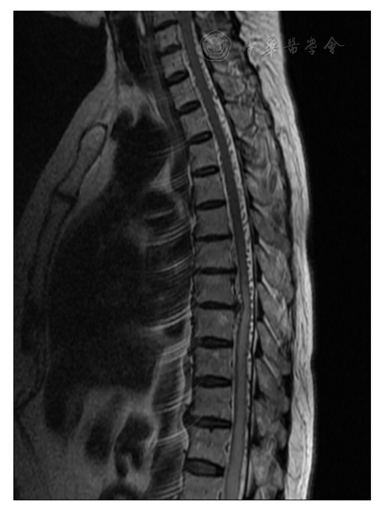 硬脊膜动静脉瘘误诊为胸椎管狭窄症一例