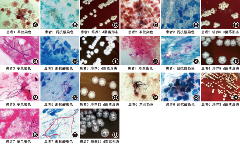 非巴西和星形奴卡菌肺部感染七例临床特征分析