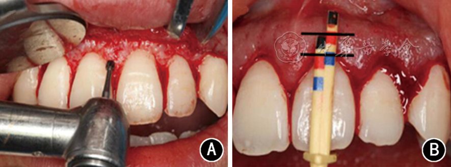 位置准确性,黑线示龈瓣复位后再次用冠延长测量尺确认龈缘及骨嵴水平