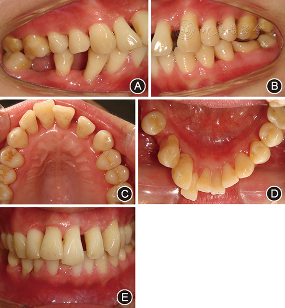重度广泛型侵袭性牙周炎牙周正畸联合治疗九年纵向观察一例