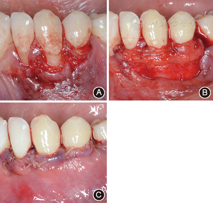 膜龈手术治疗全口多牙位牙龈退缩一例
