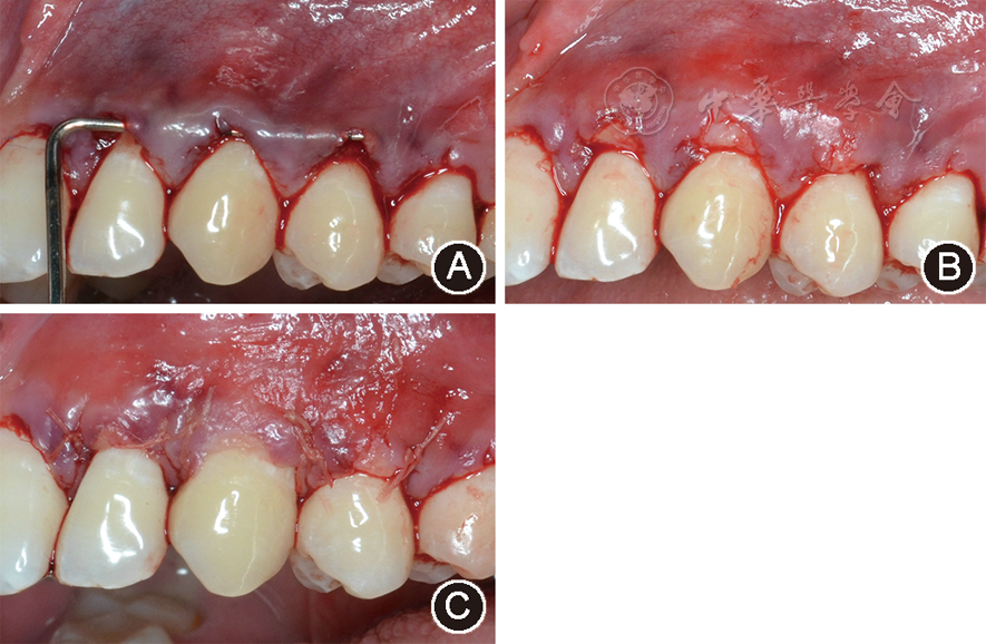 膜龈手术治疗全口多牙位牙龈退缩一例