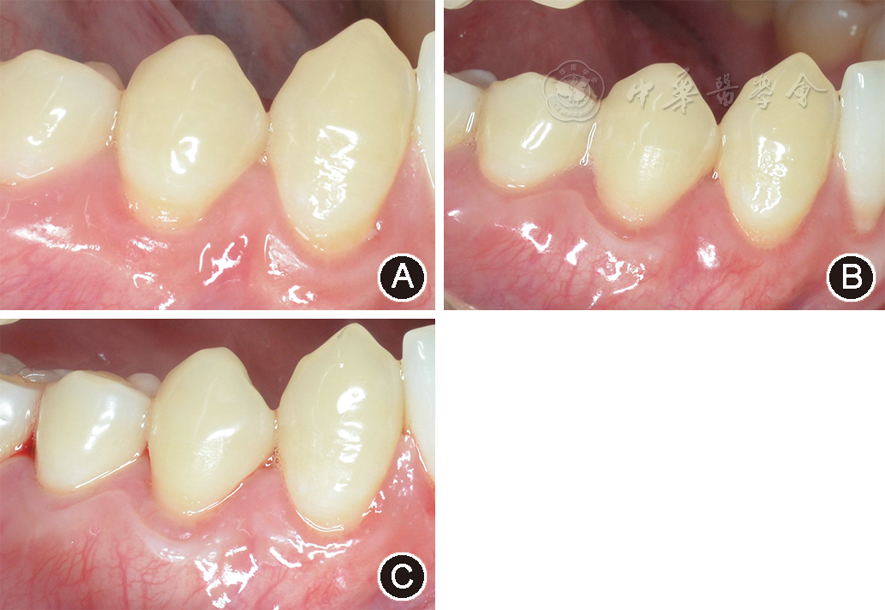 膜龈手术治疗全口多牙位牙龈退缩一例