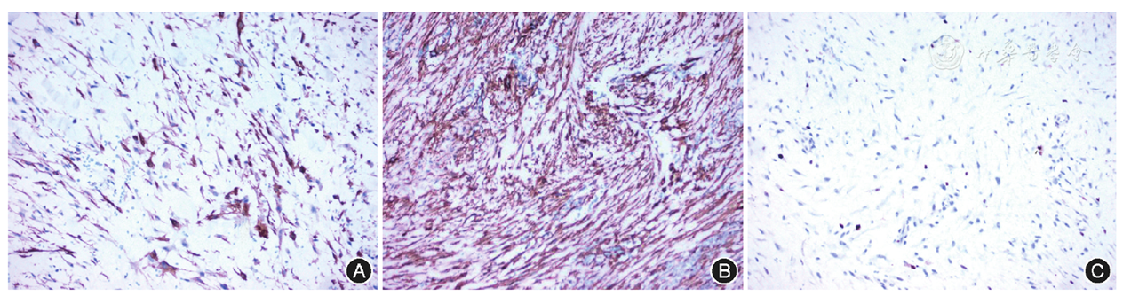 图6 骨韧带样纤维瘤患者切除肿物病理切片免疫组化染色结果(中倍放大)