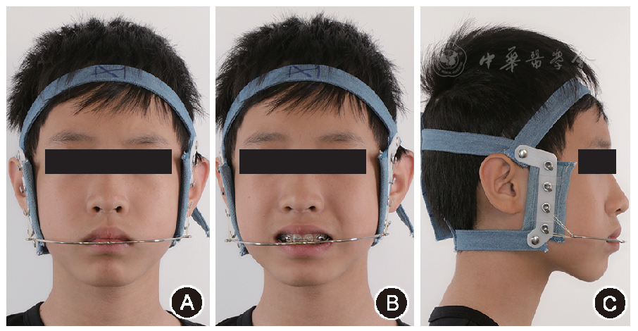 图4 骨性Ⅱ类错患者矫治9个月时(二期矫治)配戴头帽-口外弓的面像 a