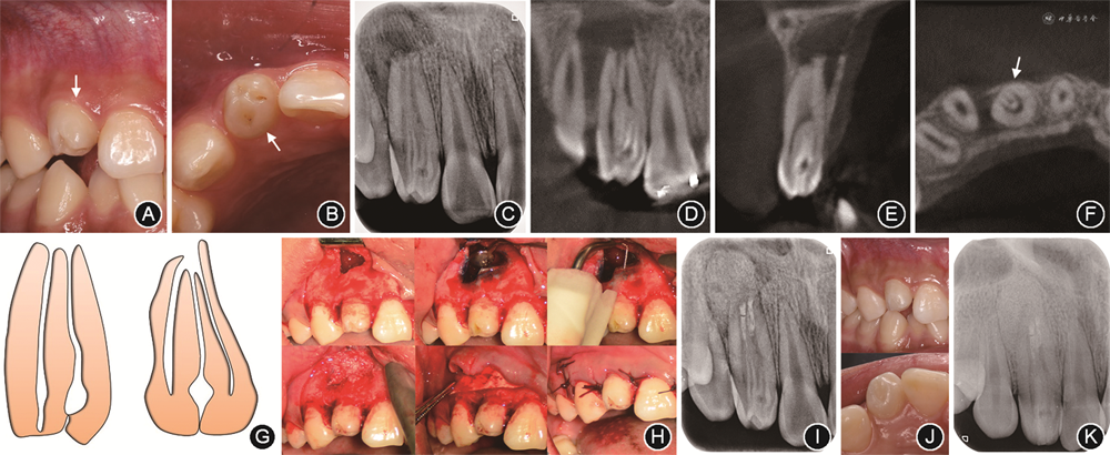 上颌侧切牙oehlersⅢ型牙内陷合并根尖周病变3例