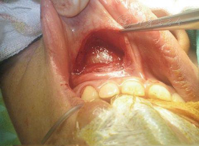 鼻前庭囊肿鼻内镜下电动切割揭盖术与唇龈沟径路切除术的临床分析