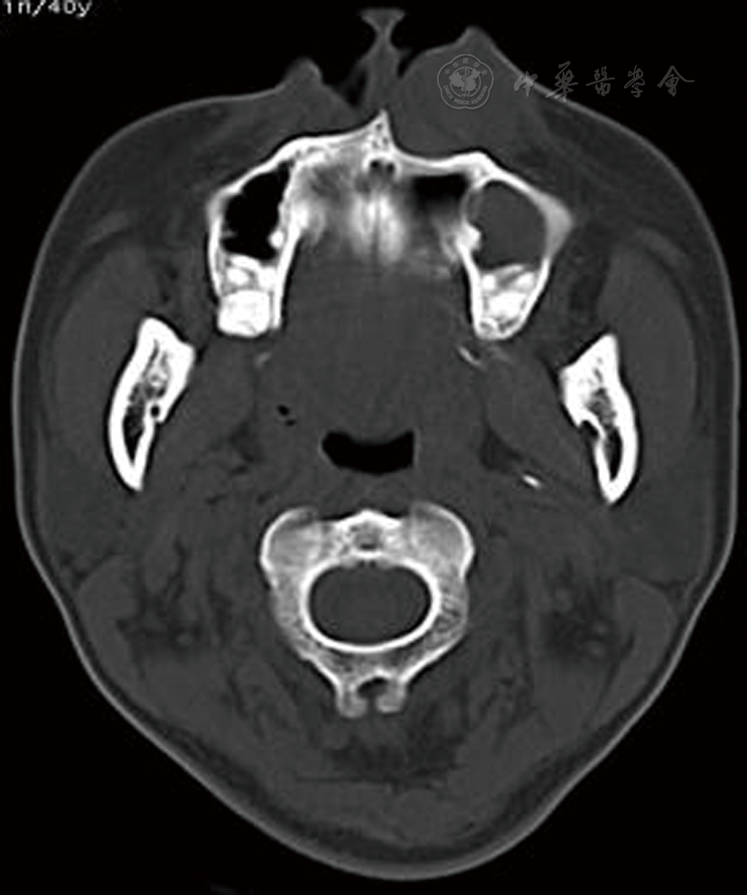 点击查看大图 图3 鼻前庭囊肿ct表现 图3 鼻前庭囊肿ct表现