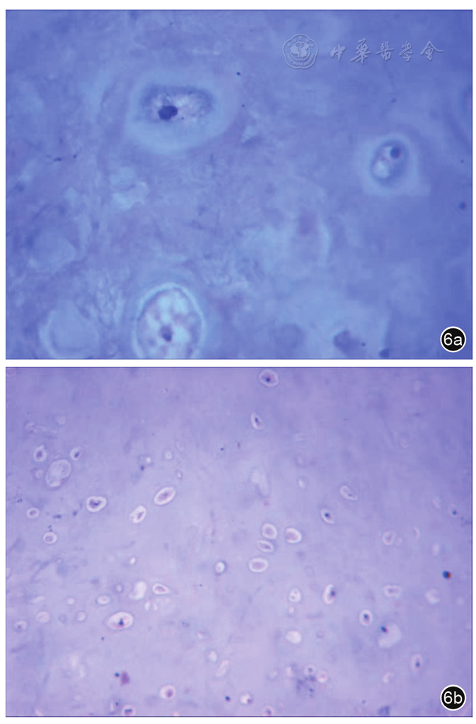 图6 软骨瘤病理图片(he染色 图a为10倍镜图,图b为40倍镜图