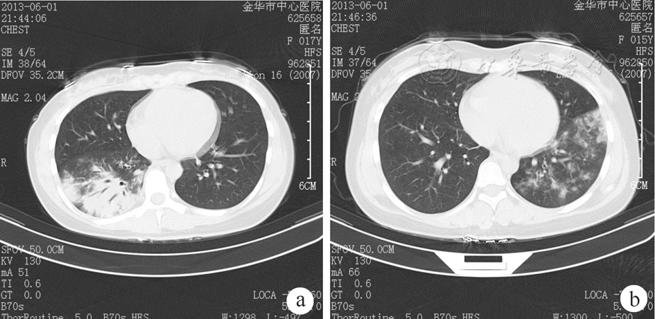 注:a.右下肺炎性病灶伴部分实变;b.