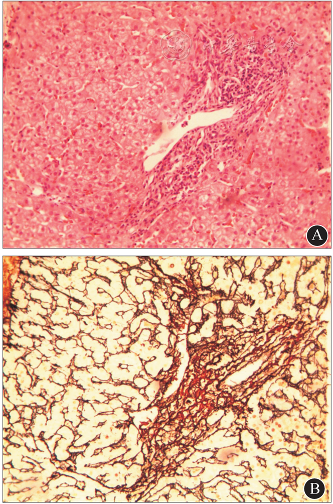 嗜银染色(×100)     患儿肝组织病理表现