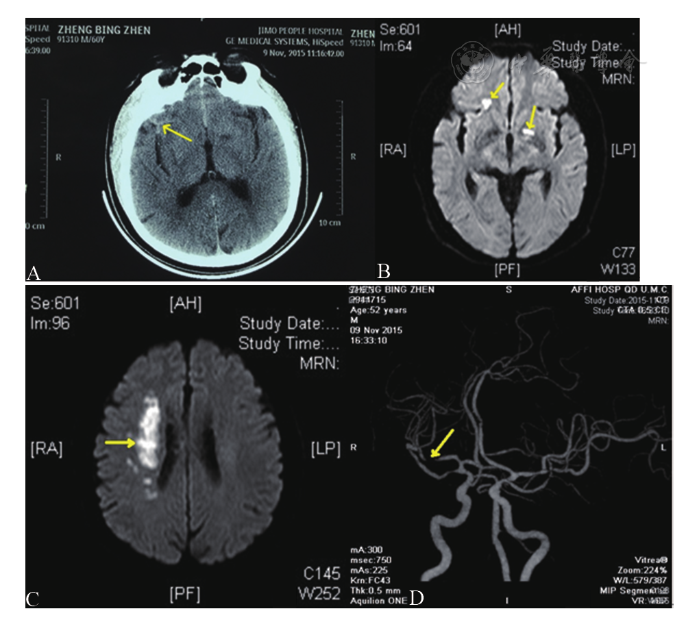 缺血性卒中后脑凸面蛛网膜下腔出血的临床和影像学特征:3例报告并文献