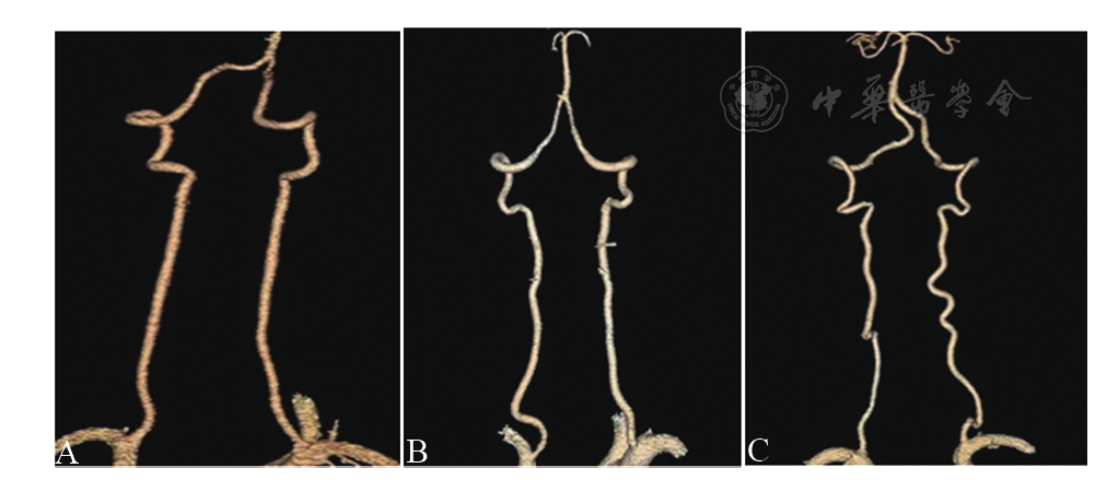 椎动脉扭曲与后循环缺血的相关性