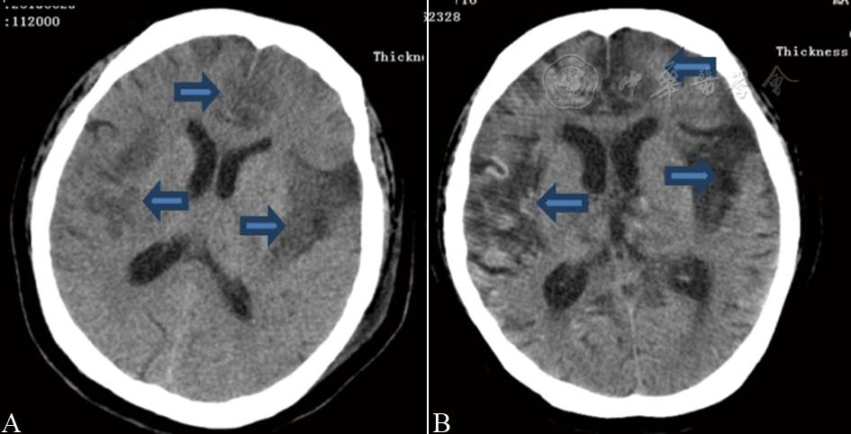 酷似缺血性卒中的病毒性脑炎:2例报道并文献复习