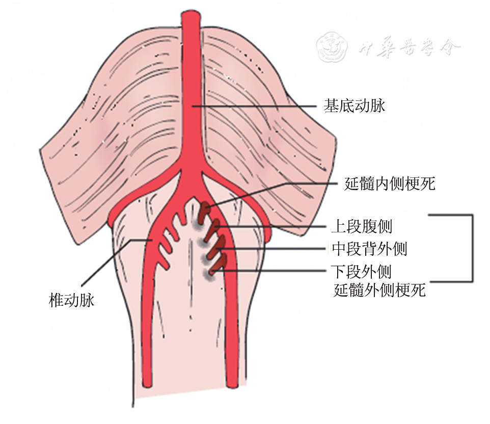 延髓梗死