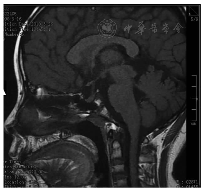 注:t1wi垂体后叶高信号未见显示 患者垂体mr平扫