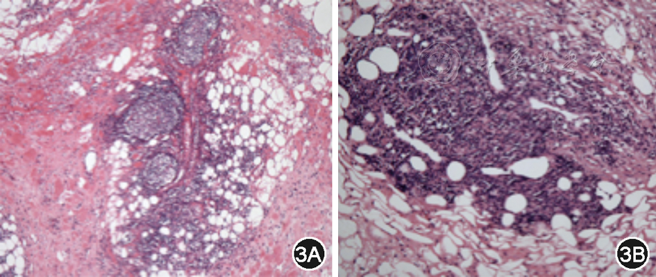 图3 病理组织学(he染色)见肠系膜脂肪组织坏死伴大量炎症细胞浸润及