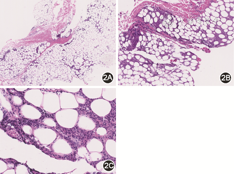 图2 患者左腰部皮肤及皮下组织活检病理示小叶性脂膜炎,脂肪小叶见