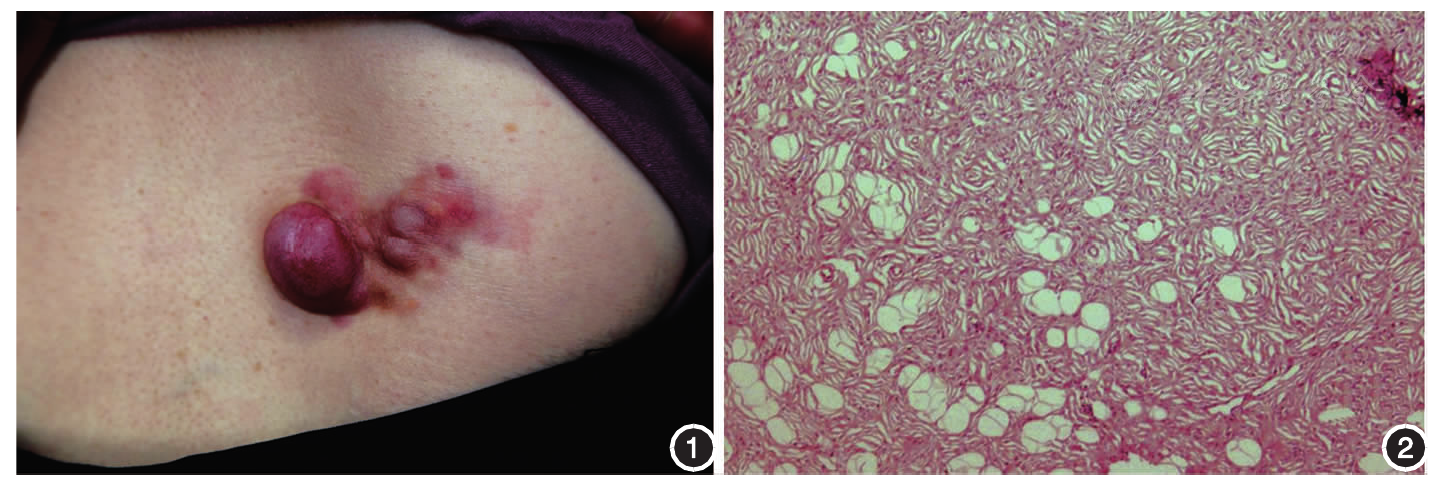 腰背部隆突性皮肤纤维肉瘤一例