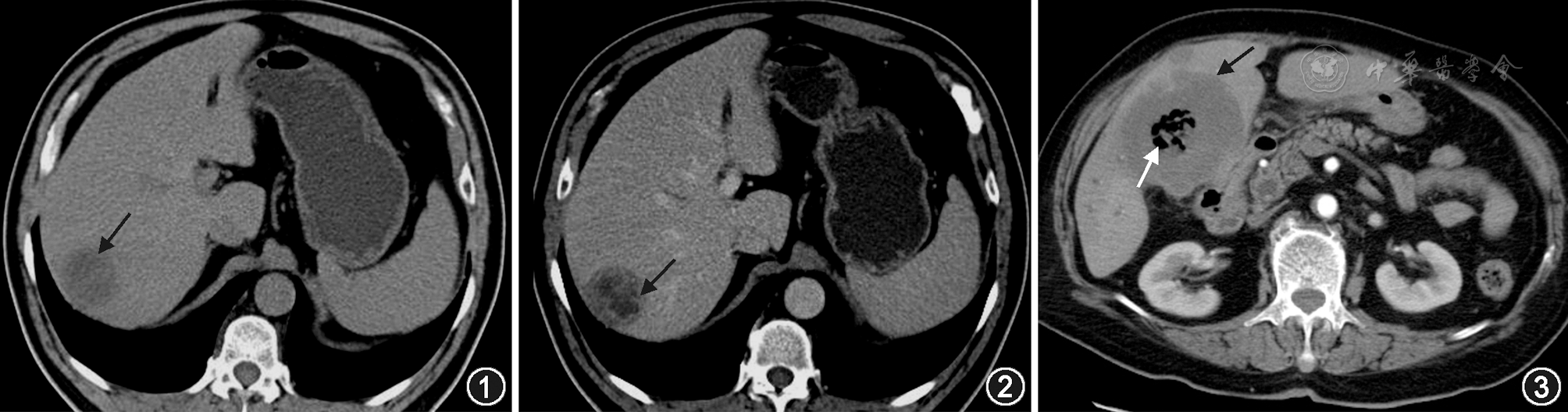 肝脓肿的ct和mri影像诊断 - 中华全科医师杂志
